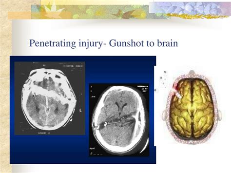 PPT Neurosensory Traumatic Brain Injury TBI Brain Tumors