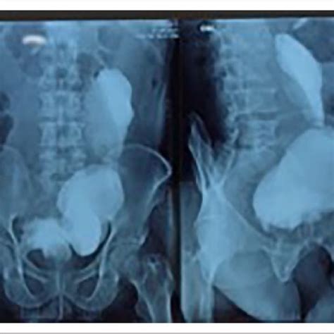 Cysto Urethrography Vcug Showing A Large Diverticulum With Narrow