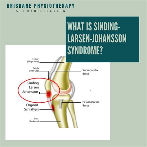 What Is Sinding Larsen Johansson Syndrome Brisbane Physiotherapy