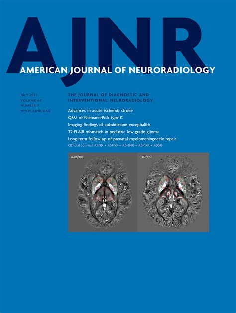 Sex Specific Patterns Of Cerebral Atrophy And Enlarged Perivascular Spaces In Patients With