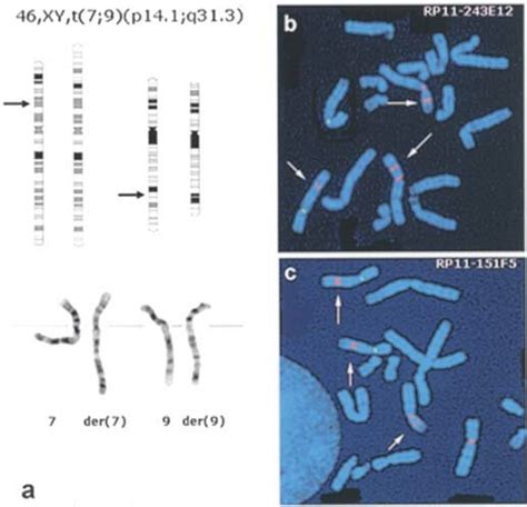 A Partial Karyotype And Schematic Representation Of The De Novo