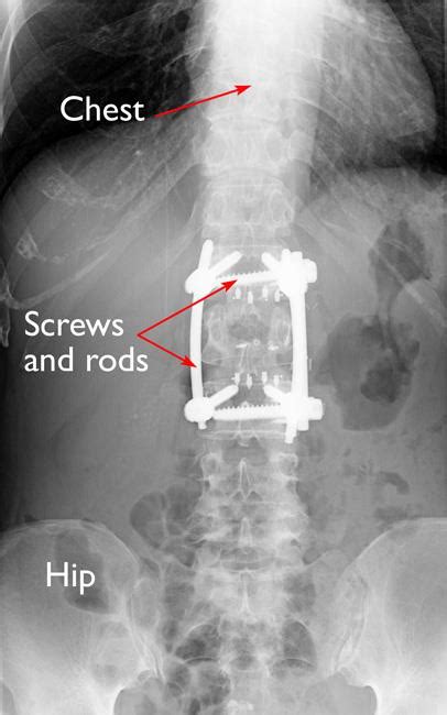 Fractures of the Thoracic and Lumbar Spine - OrthoInfo - AAOS