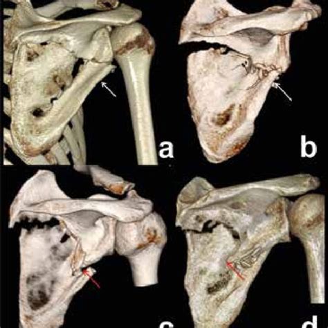 Fractures Of Scapular Neck Right Scapula Posterior View With Download Scientific Diagram