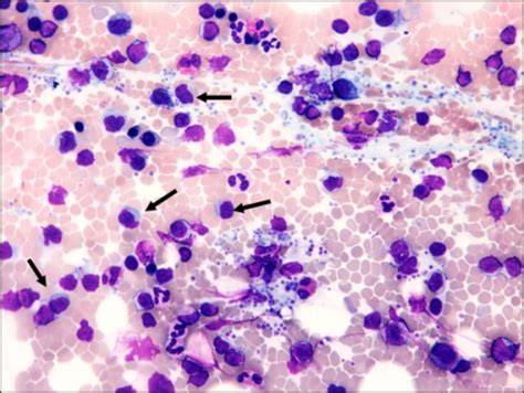 Waldenström s macroglobulinemia bone marrow aspiration and biopsy wikidoc