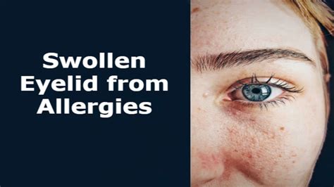 Understanding Swollen Eyelids From Allergies Causes Symptoms And