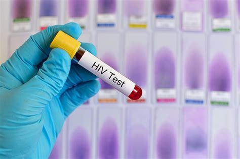 Ketahui Ciri Ciri HIV Ketika Pertama Kali Terinfeksi