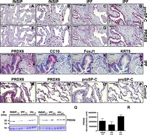 Expression Analysis Of Peroxiredoxin Prdx In Lungs From Patients