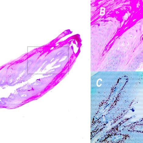 Cutaneous horn. The cutaneous horn is located on a on 70-year-old man's ...