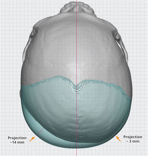 Plastic Surgery Case Study Custom Skull Implant For Back Of Head