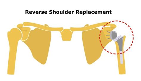 Tips For Reverse Shoulder Replacement Rehab Bella Vista San Diego Ca