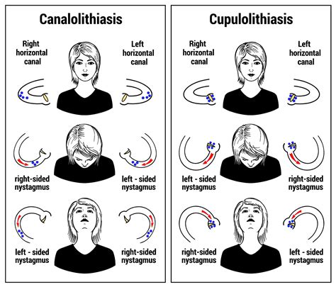 The Intricate Connection Between Tinnitus And Brain Tumors A