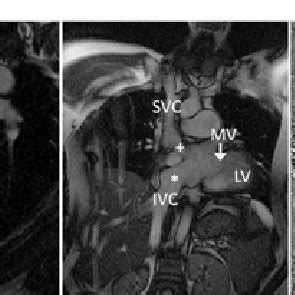 Tga Tga After Atrial Switch Operation With Mustard Procedure A The