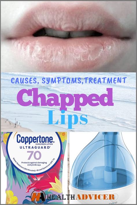 Chapped Lips Causes Picture Symptoms And Treatment