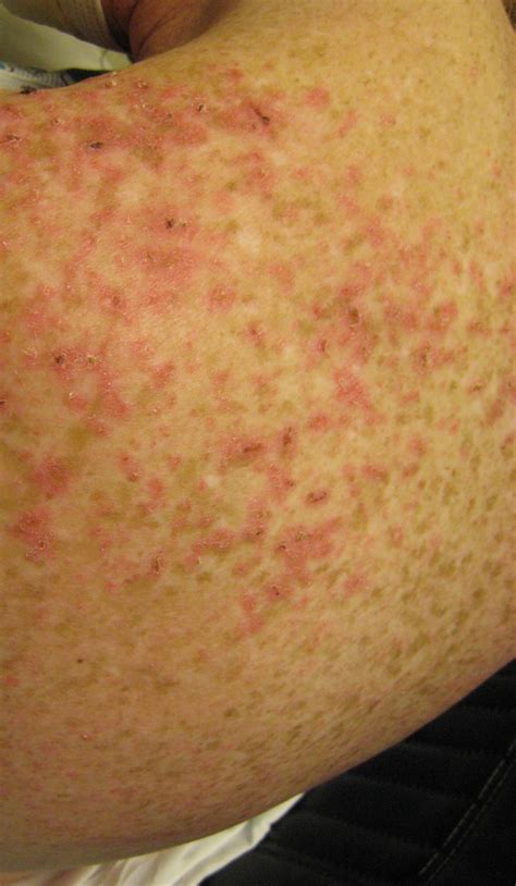 Lupus Rash On Hands