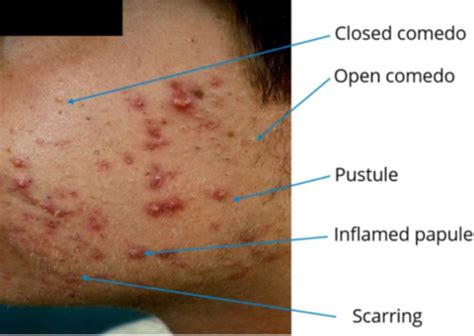 Acneiform Lesions Flashcards Quizlet