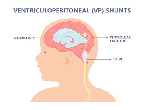 Ventriculoperitoneal Shunt Hart Garner MD Minnesota Spinal