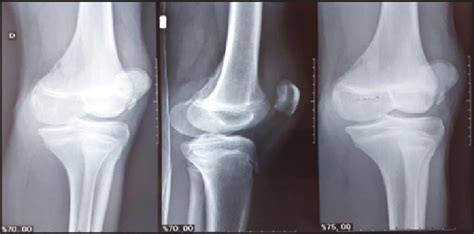 Radiografias em Perfil e Oblíquas demonstrando fragmento Download