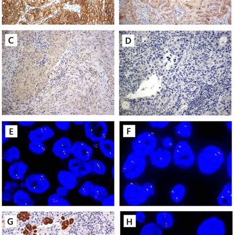 Anaplastic Lymphoma Kinase Alk Immunohistochemistry Ihc Staining