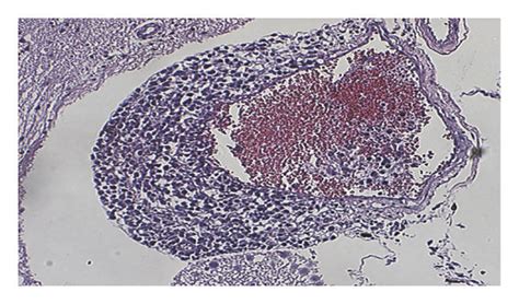 Histological and immunohistochemical staining of intravascular lymphoma... | Download Scientific ...