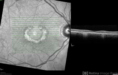 Oct Of Plaquenil Maculopathy Retina Image Bank