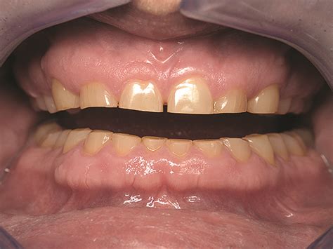 Occlusal Problems Blog Knak Jp