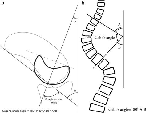 How To Measure Scapholunate And Cobbs Angles On Mri And Ct Abstract