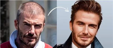 David Beckham Hair Transplant 2022 – 2023 – New Images ! in 2022 ...