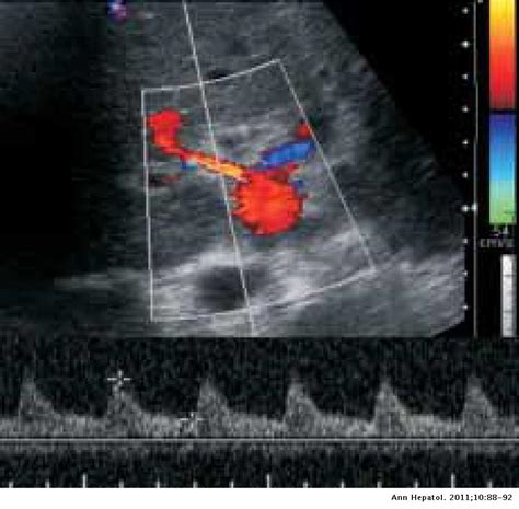 Arcuate ligament compression as a cause of early-onset thrombosis of ...