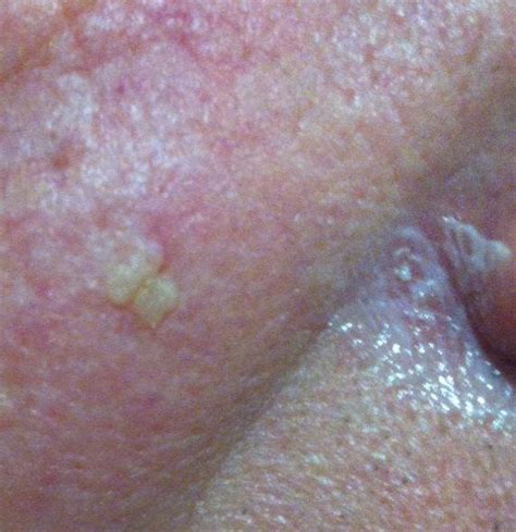 Actinic Keratosis ICD 10 L57 Online Consultation AI Dermatologist