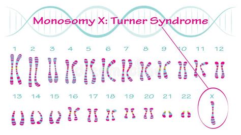 Monosomy Turner Syndrome