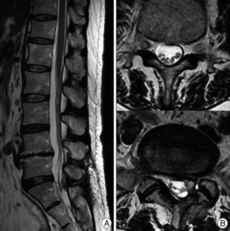 Sagittal A And Axial B Postoperative Magnetic Resonance Imaging