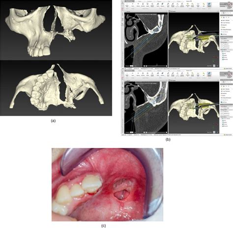 Are Zygomatic Implants A Simple And Reliable Technique For The