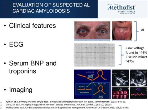 Multiple Myeloma And Al Amyloidosis