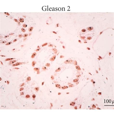 Segmentation And Binarisation Of Argyrophilic Nucleolar Organizer