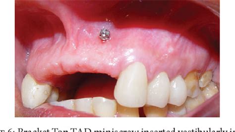 Figure 1 From Dental Extrusion With Orthodontic Miniscrew Anchorage A Case Report Describing A