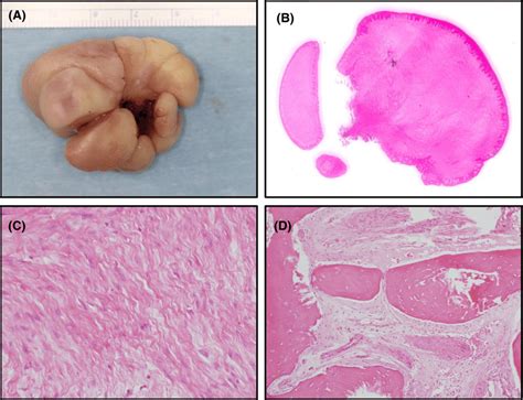 Histological Analysis A Gross Appearance Of The Resected Specimen A