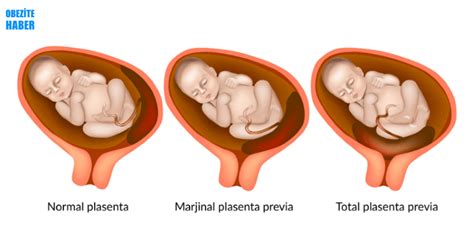 Gebelikte Plasenta Previa Nedir Durumu Nasıl Olmalıdır Obezite Haber