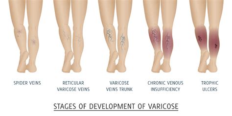 Venous Insufficiency Causes And Treatments For All Ages