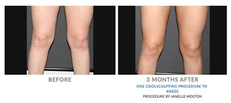 13 Coolsculpting Knees Taimoortyler