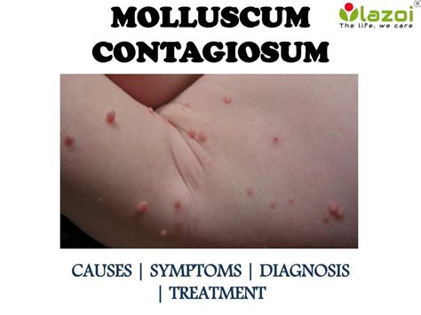 Ppt Molluscum Contagiosum Causes Symptoms And Treatment Powerpoint Presentation Id 7542185