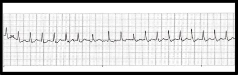 Float Nurse: Practice EKG Strips 382