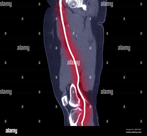 Cta Femoral Artery Run Off Image Of Femoral Artery For Diagnostic Acute