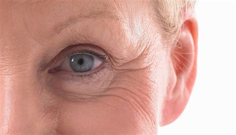 Understanding Belpharoplasty Eyelid Plastic Surgery