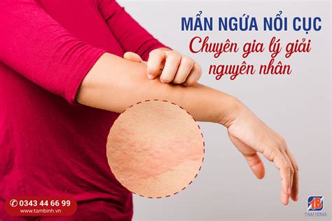 Mẩn ngứa nổi cục là gì Nguyên nhân và cách điều trị