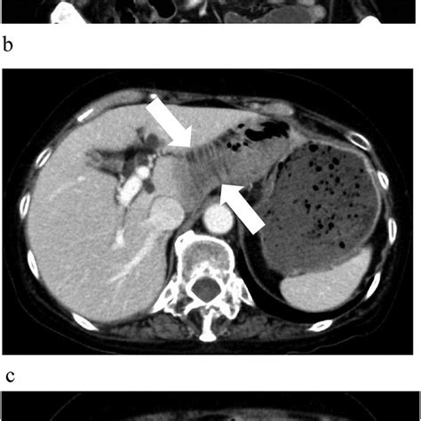 Abdominal Contrast Enhanced Ct Scans A B C The Small Intestine