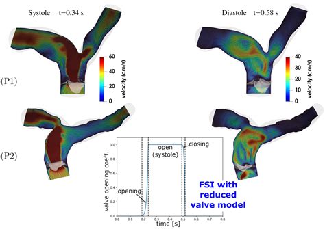 New MOX Report On Computational Haemodynamics For Pulmonary Valve