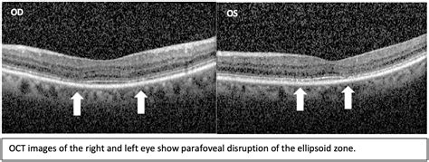 Asymptomatic And Early Hydroxychloroquine Retinal Toxicity Noted On Oct