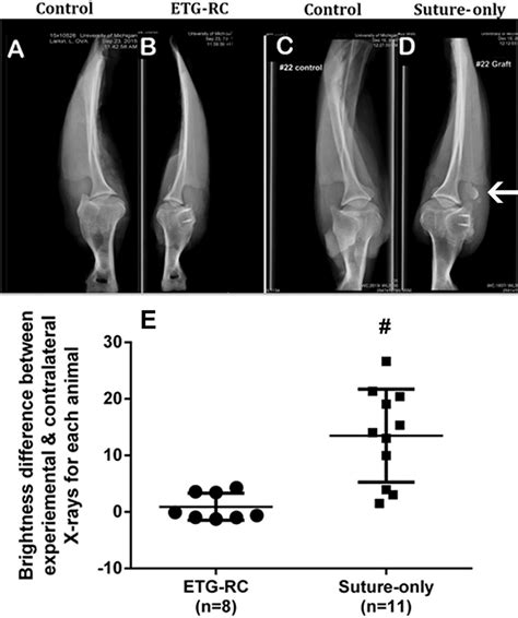 Infraspinatus Tendon Mineralization A Control Of Etg Rc Repair B