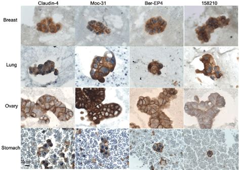 Immunocytochemistry Showing Overexpression In Adenocarcinoma Of Breast