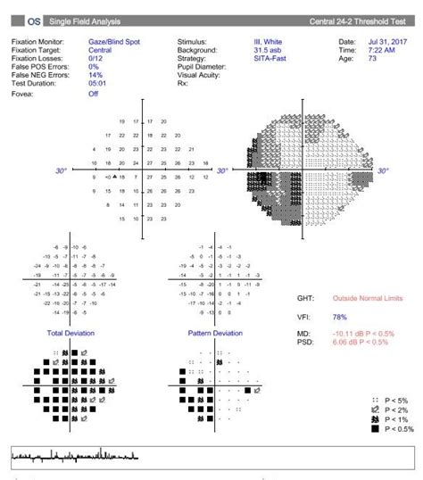 Oct Macular Ganglion Cell Analysis Helps Identify Neurological Disease